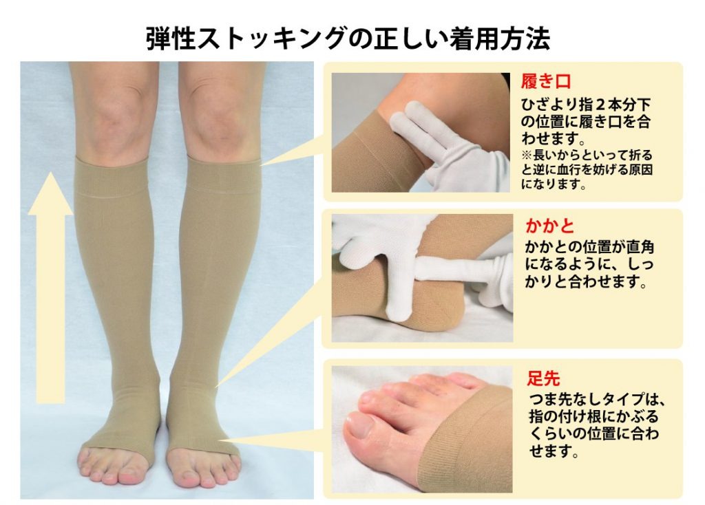 医療用弾性ストッキング どこで買える？購入先と選び方、保険適用を解説